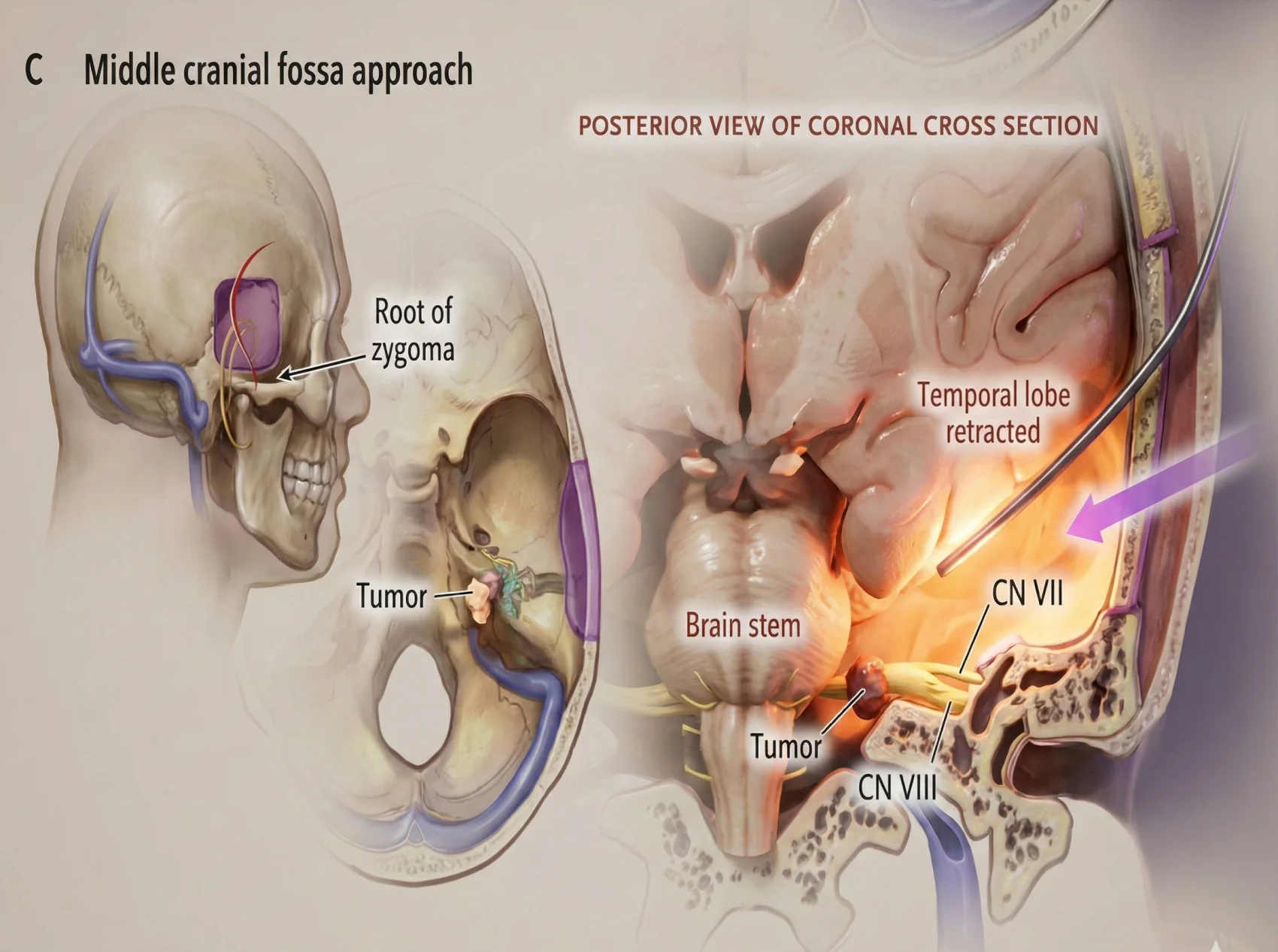 Via da fossa craniana média para acesso a schwannoma vestibular, preservando audição e nervo facial.