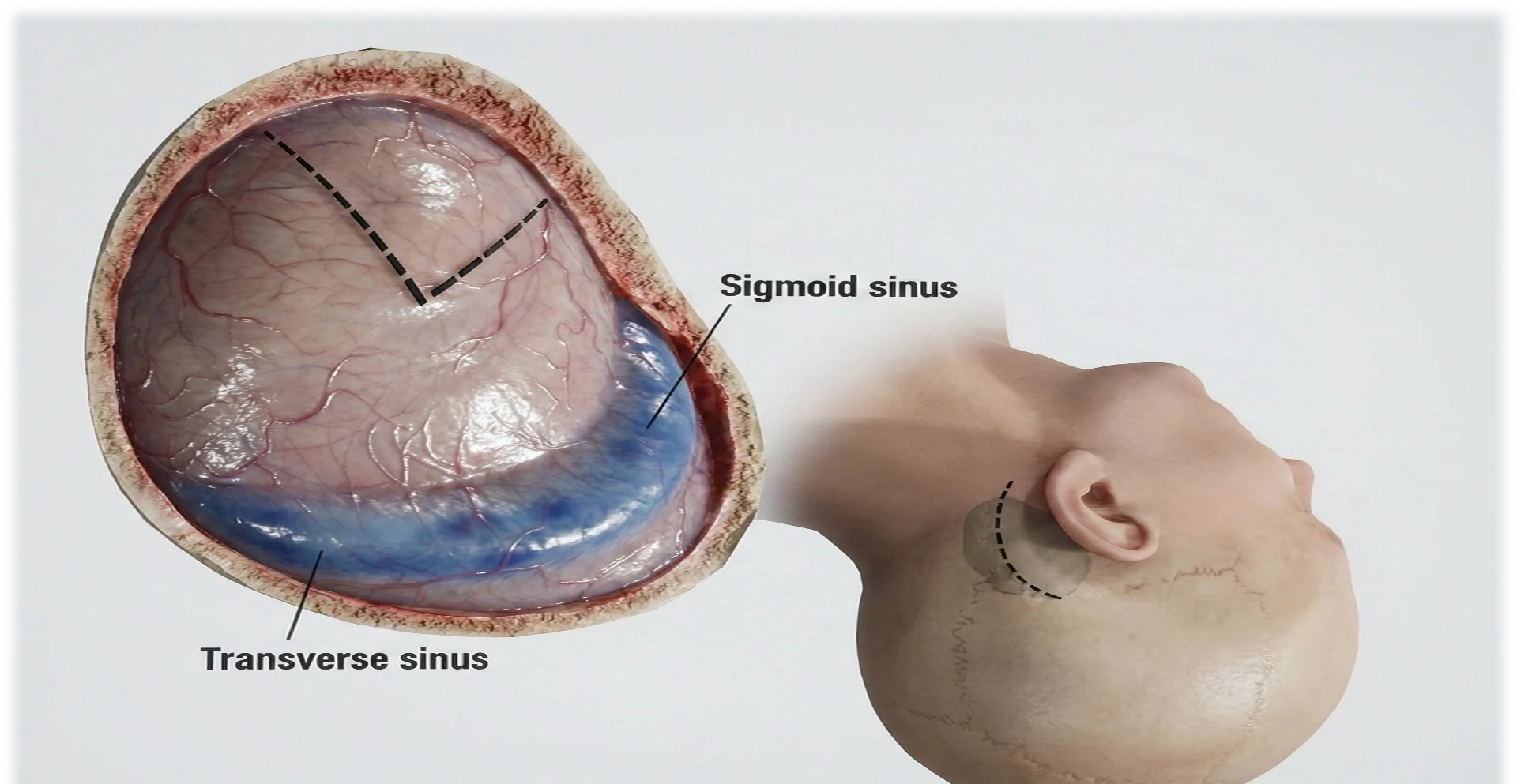 Via retrossigmoidea: craniotomia atrás da orelha com exposição dos seios transverso e sigmoide.